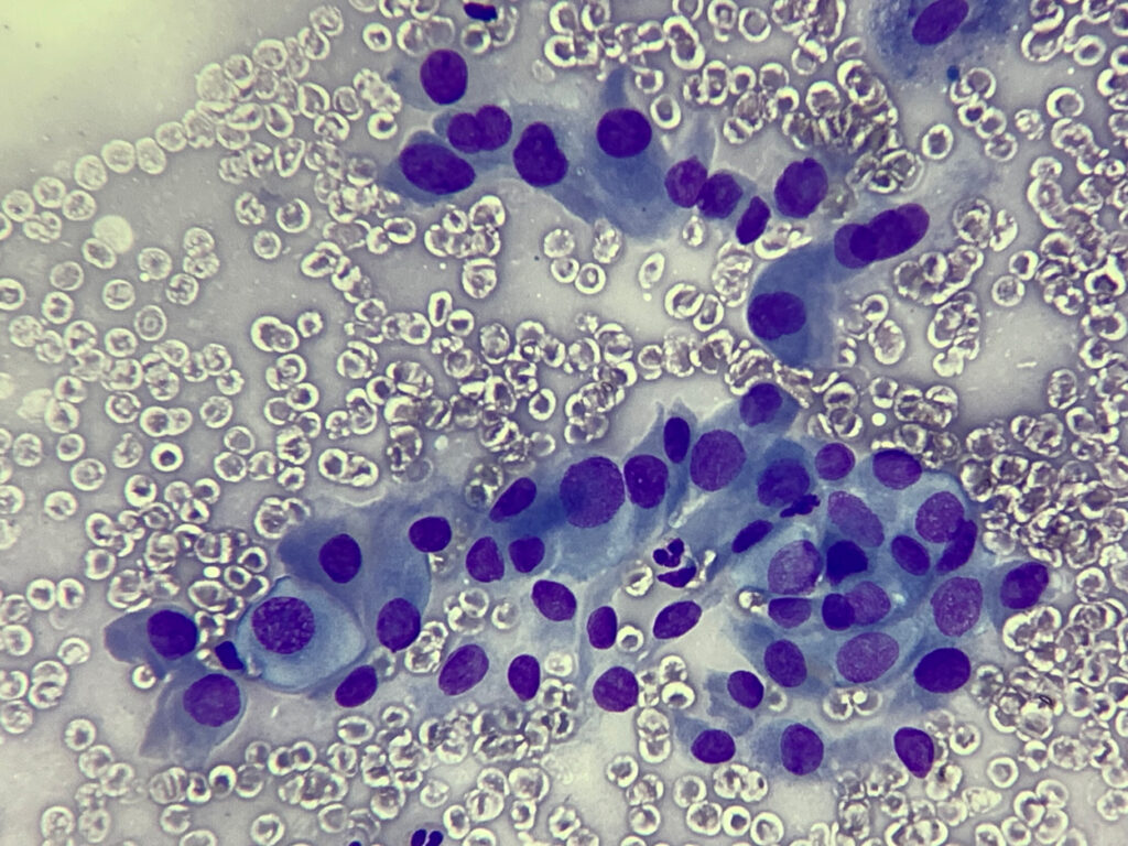 Biopsia por aspiración con aguja fina laboratorio de patología gamapath